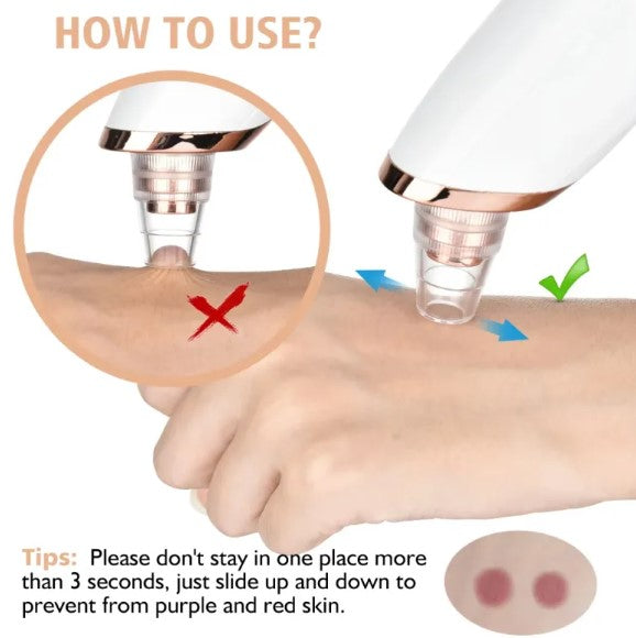 Blackhead Remover