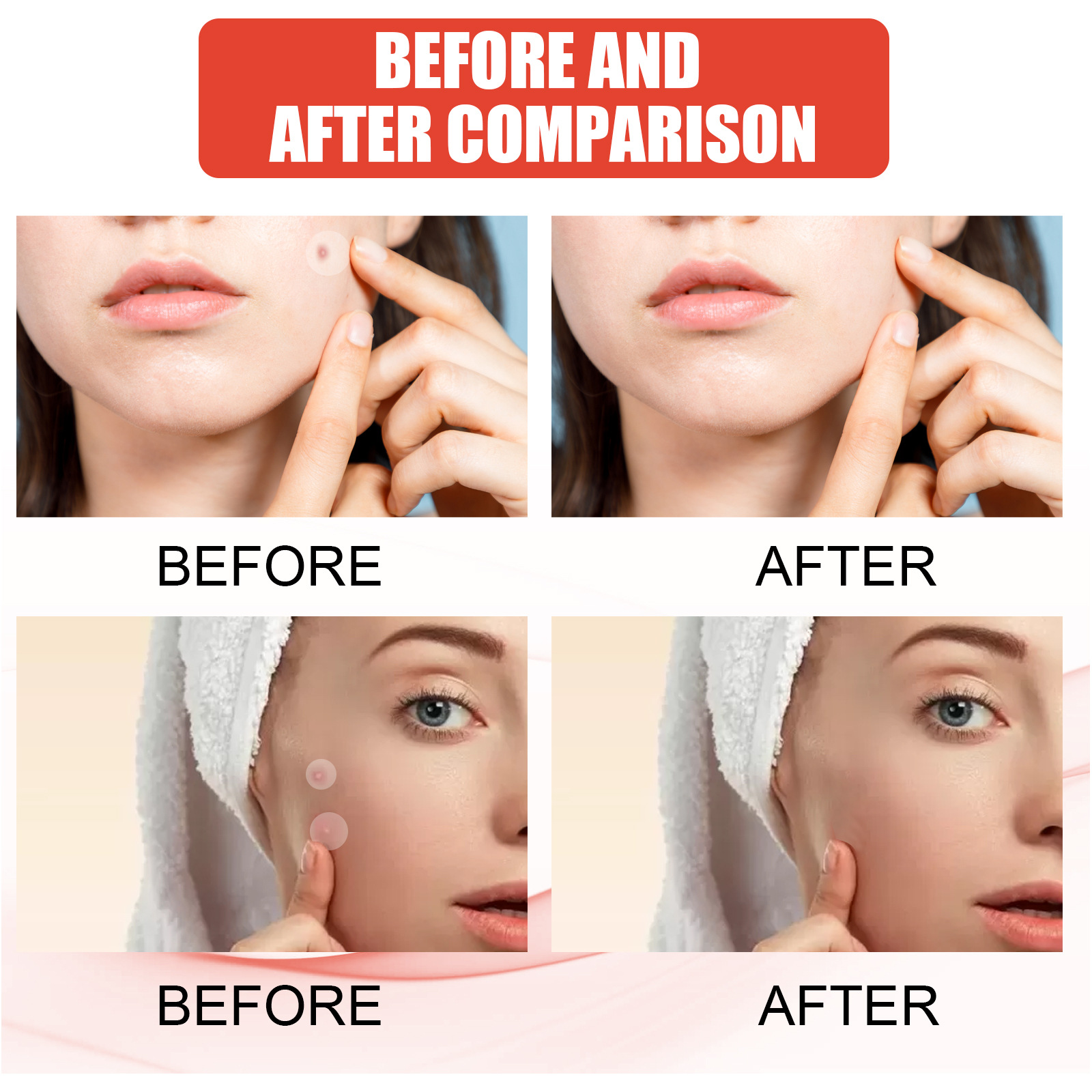 Invisible Hydrogel Acne Patch